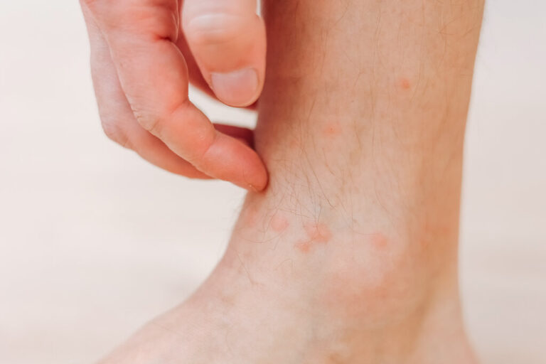 Person scratching a rash caused by bed bug bites